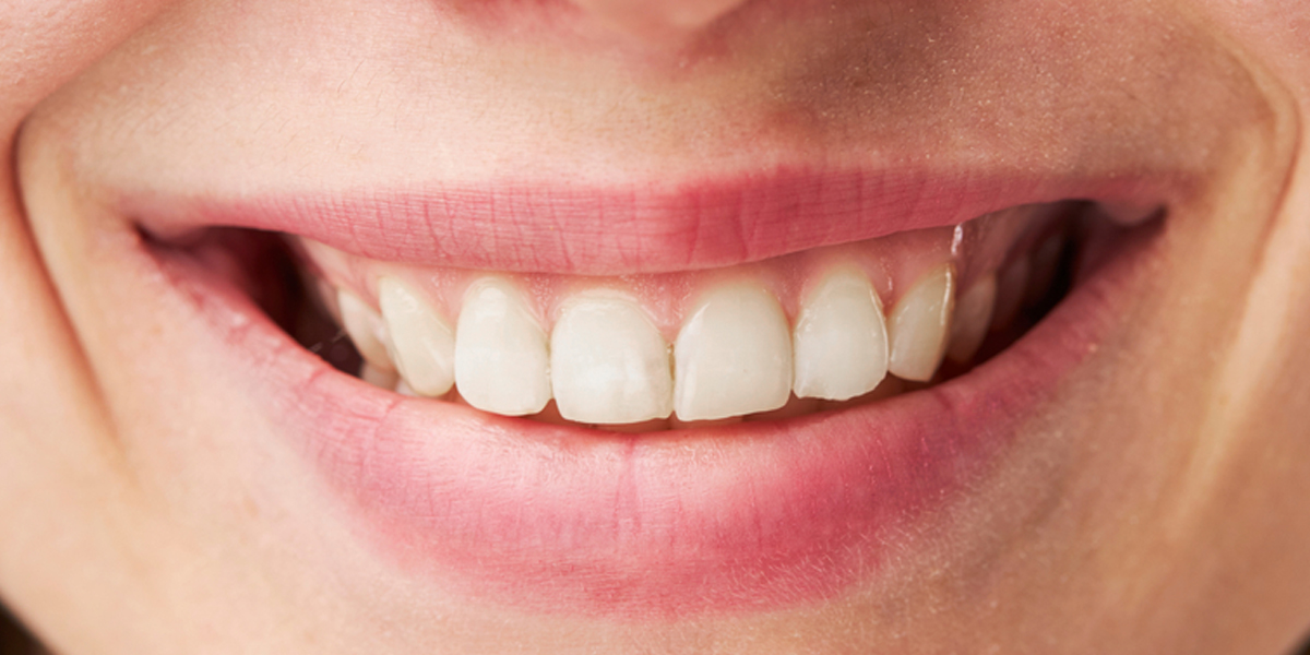 The-Ivory—Single-Session-Teeth-Whitening-Results-Rachel-W