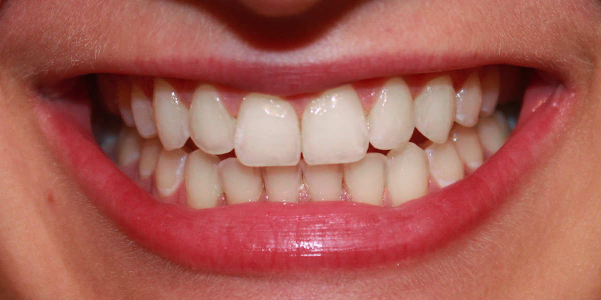 The-Ivory—Single-Session-Teeth-Whitening-Results-Sonja-R